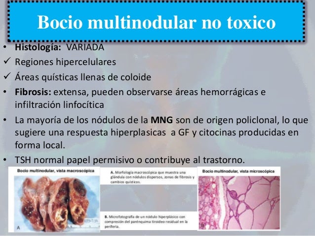 bocio multinodular eutiroideo